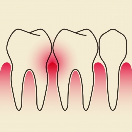 gingivitis natural cures